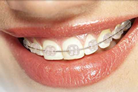 ceramic-braces