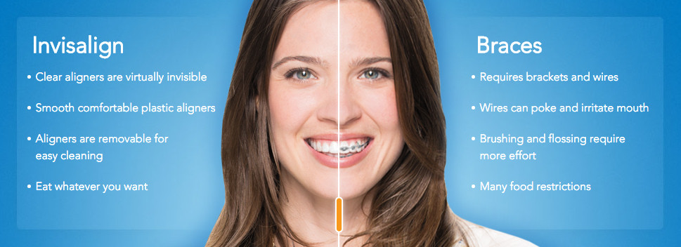 Inner Richmond Invisalign, Menlo Park Invisalign,Antioch Invisalign,Hercules Invisalign,Financial District Invisalign,Atherton Invisalign,Milpitas Invisalign