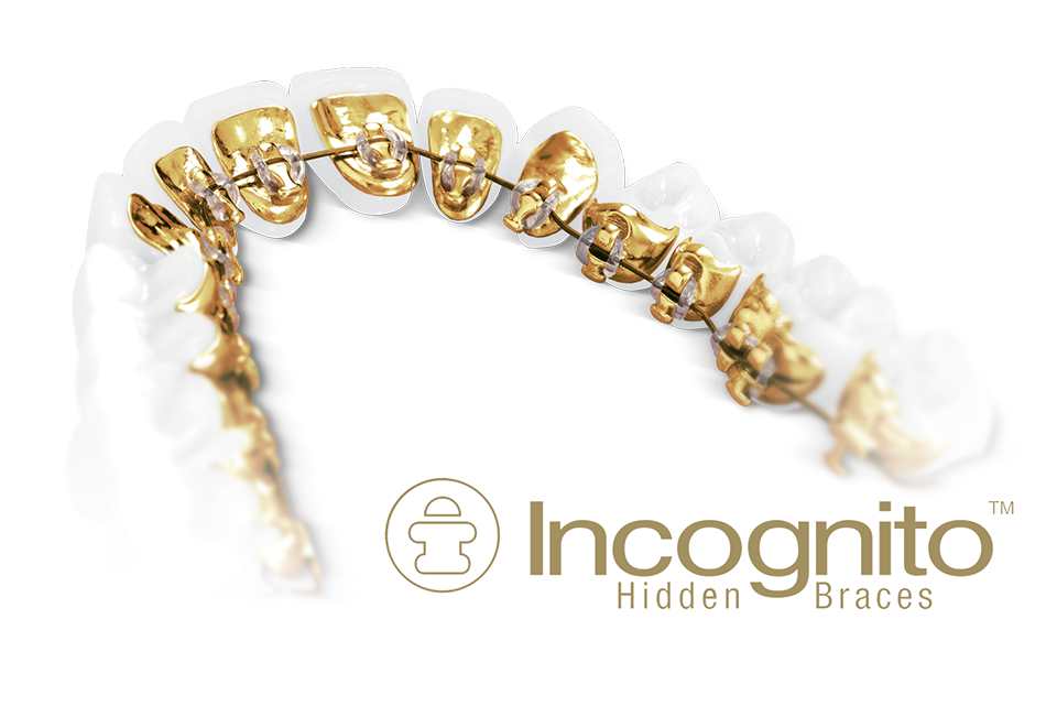 Incognito Braces